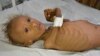 FILE - In this photo taken Sept. 9, 2016, Salem, 5, who suffers from malnutrition, lies on a bed at a hospital in the port city of Hodeidah, southwest of Sana'a, Yemen. 
