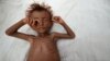 A malnourished boy lies on a bed outside his family's hut in al-Tuhaita district of the Red Sea province of Hudaydah, Yemen, Sept. 26, 2016.